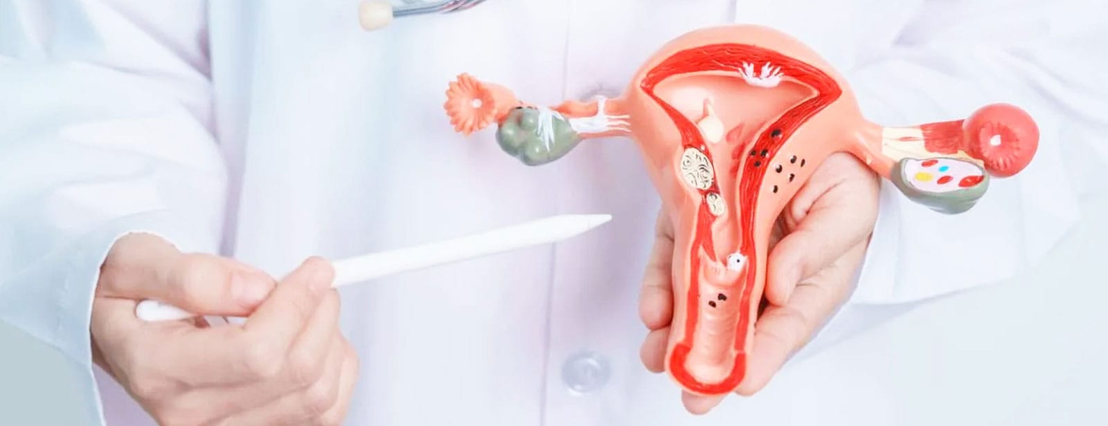 Polycystic Ovary Syndrome